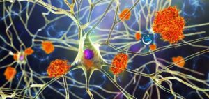 Read more about the article New Hope in Alzheimer’s Treatment from Latest Antibody-based Therapy