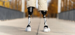 Read more about the article Advancements in Prosthetics