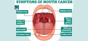 Read more about the article Regular Dentists checkup helps Identify Early Signs of Cancers from Bad Breath to Wobbling teeth
